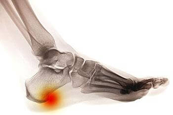 heel spur treatment in the Palm Beach County, FL: Boynton Beach, West Palm Beach, Delray Beach & Boca Raton, Lantana & Lake Worth Beach, Ocean Ridge & Gulf Stream, Hypoluxo, Wellington, Greenacres, FL & Broward County, FL: Plantation, Davie, Cooper City, Lauderhill & Lauderdale Lakes, Weston, Pembroke Pines & Miramar, FL areas
